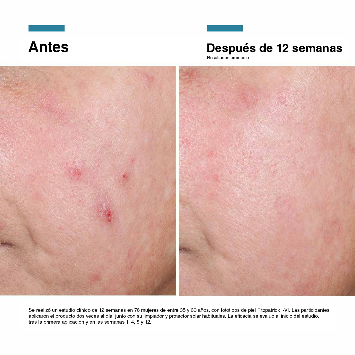 Caso clínico documentado con Advanced RGN-6 de SkinCeuticals