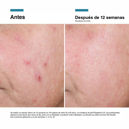 Caso clínico documentado con Advanced RGN-6 de SkinCeuticals