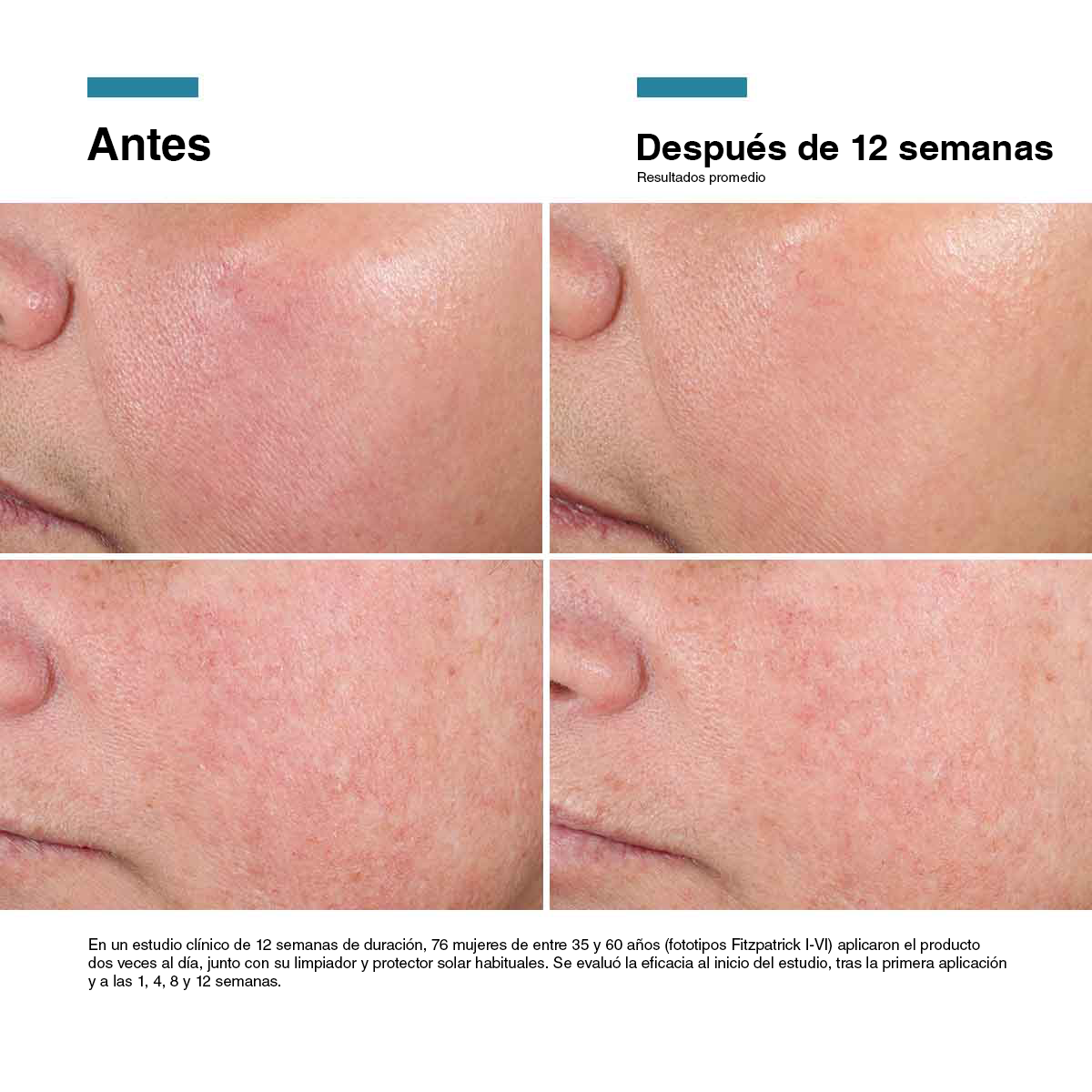 Segundo caso clínico documentado con Advanced RGN-6 de SkinCeuticals
